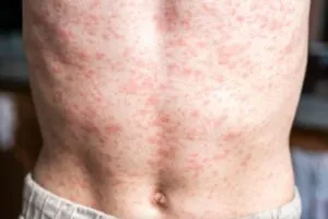 Brote de sarampión en México lleva 28 muertes