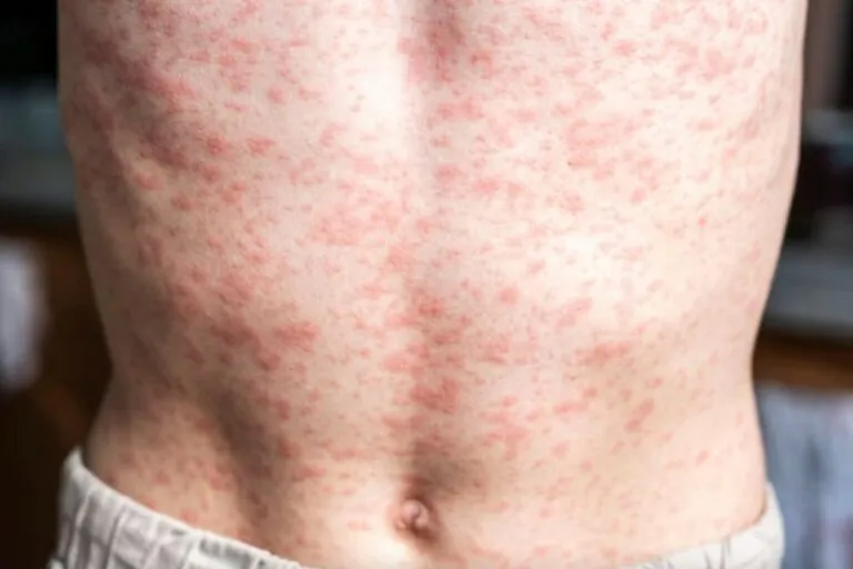 Brote de sarampión en México lleva 28 muertes